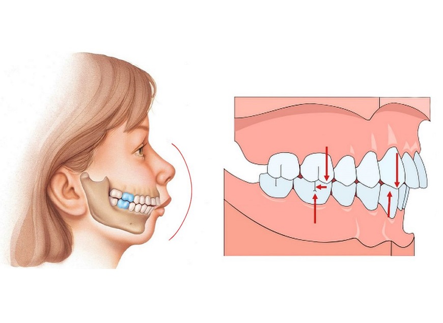 arxikh-2.1 Ποιες είναι οι αιτίες των ορθοδοντικών προβλημάτων;
